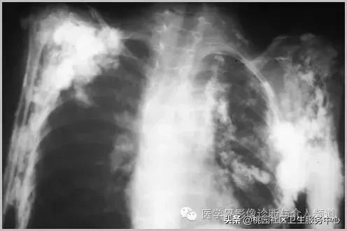 软组织钙化是不是骨化性肌炎,软组织钙化或骨化