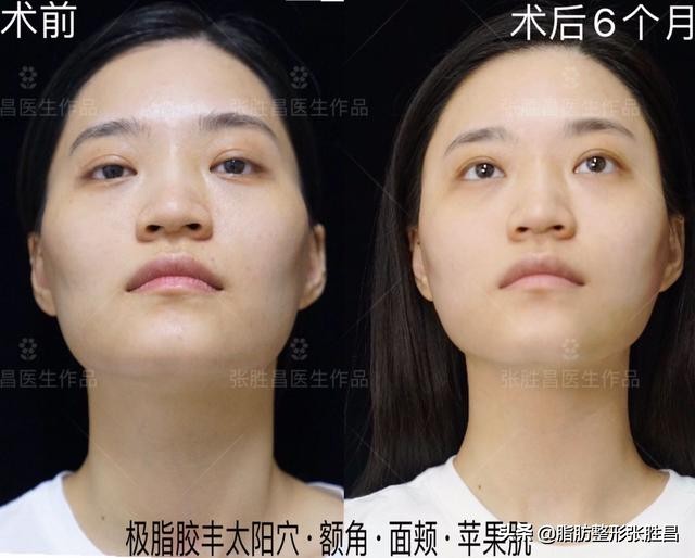 自体脂肪胶填充太阳穴泪沟法令纹,自体脂肪太阳穴填得太饱满了