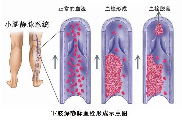静脉曲张、静脉血栓，有区别？有联系？要处理？请听专业的回答