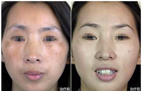 皮秒激光就是镭射净肤吗,皮秒激光是怎么样的