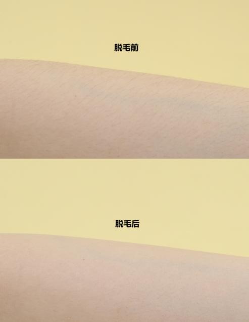 脱毛仪和猕猴桃哪个好,猕猴桃脱毛仪深度评测