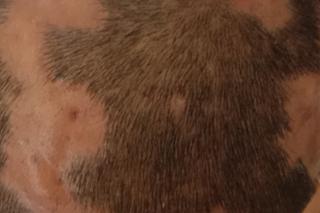 寻常性毛囊炎图片,穿掘性毛囊炎真实照片