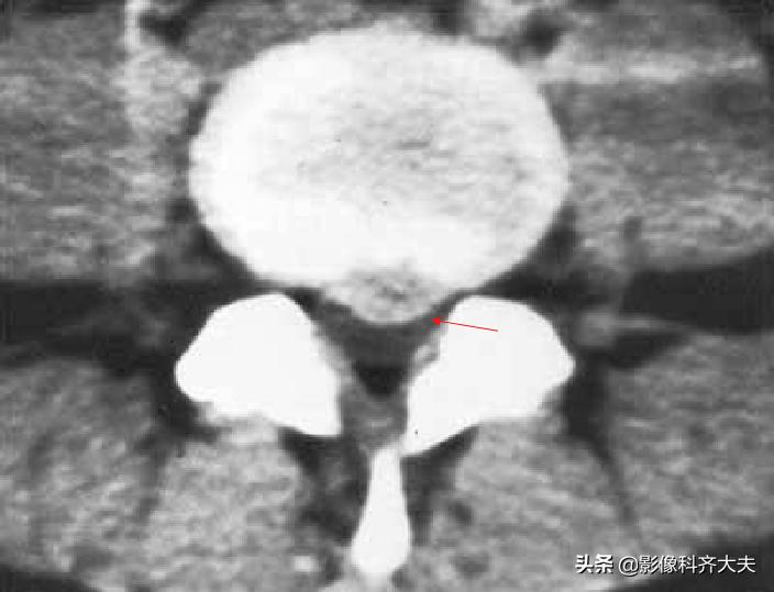 腰椎间盘突出的影像学诊断及治疗,腰椎间盘突出影像学课件
