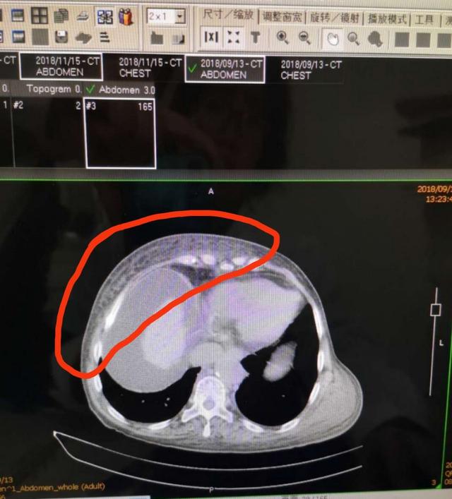 肝硬化腹水中药治好病例,肝硬化腹水中医辨证论治