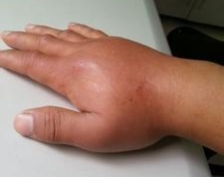 如果不小心被蜜蜂蛰到脚上怎么办,如果不小心被蜜蜂蛰了该怎么办