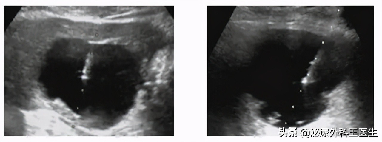 体检发现肾囊肿怎么办,体检中常见肾囊肿怎么治疗