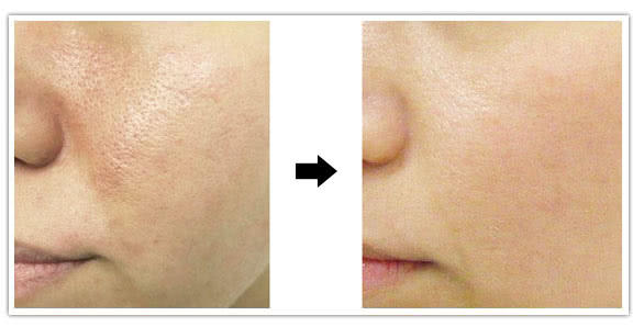 微针美容是否适合你一份详细指南,毛孔粗痘坑用什么微针精华