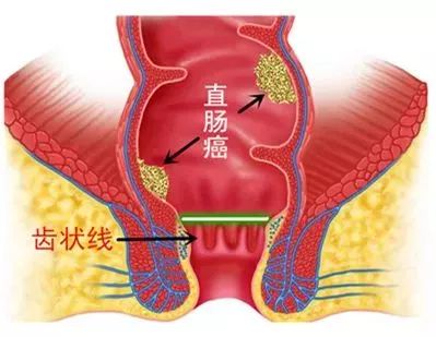 痔疮有便血肛门瘙痒需要手术吗,痔疮肛门坠胀便血咋办