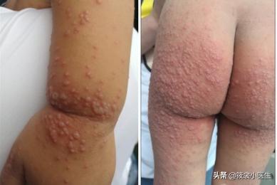 手足口病容易和哪些病混淆,儿科医生手足口病