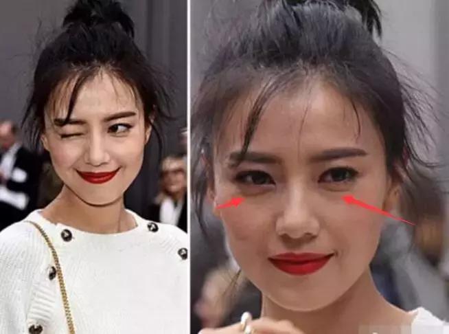 眼袋怎么消除简单方法男生,黑眼袋怎么消除最快方法男士