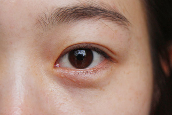 眼部周围长了小痘痘该怎么去除,眼部出现小颗粒痘是怎么回事