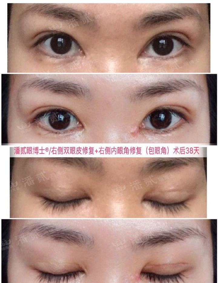 开眼角手术如何避免回缩,开眼角手术常见问题及解决方法