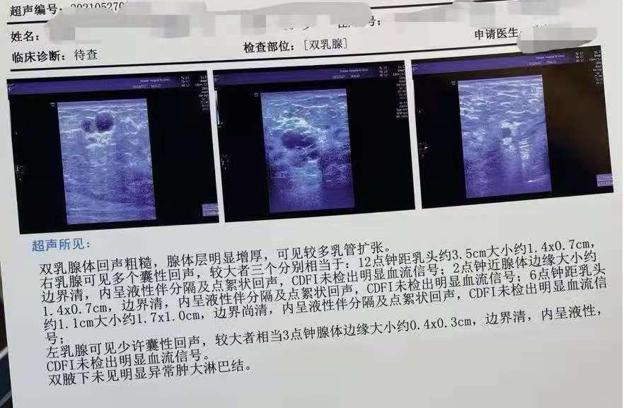 哺乳期乳房疙疙瘩瘩，影响喂奶吗？