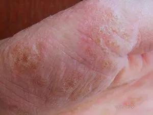 农村治脚气的土方子中华医药,湘西老中医治疗脚气的药方