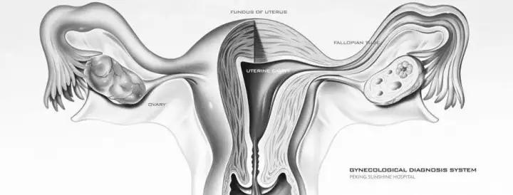 怀孕检查出来卵巢癌,以为怀孕了结果出现肿瘤