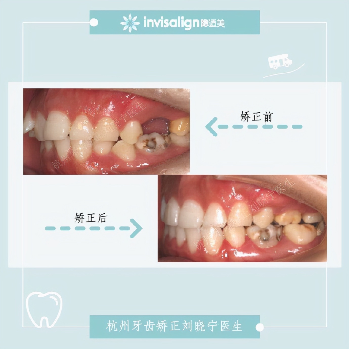 矫正牙齿如何改善露龈笑,矫正牙齿可以改善露龈笑吗