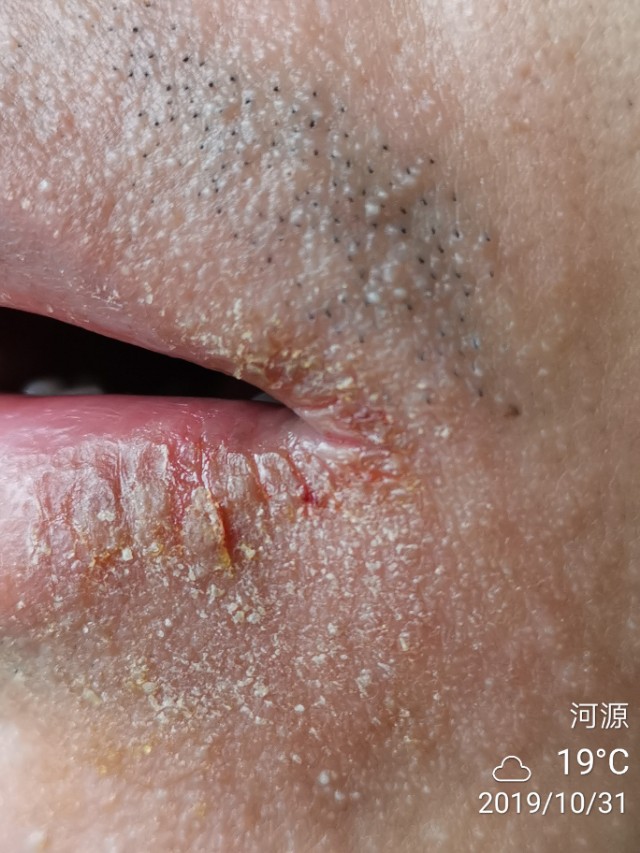 冬季多发口角炎（烂嘴角），中医怎么治？