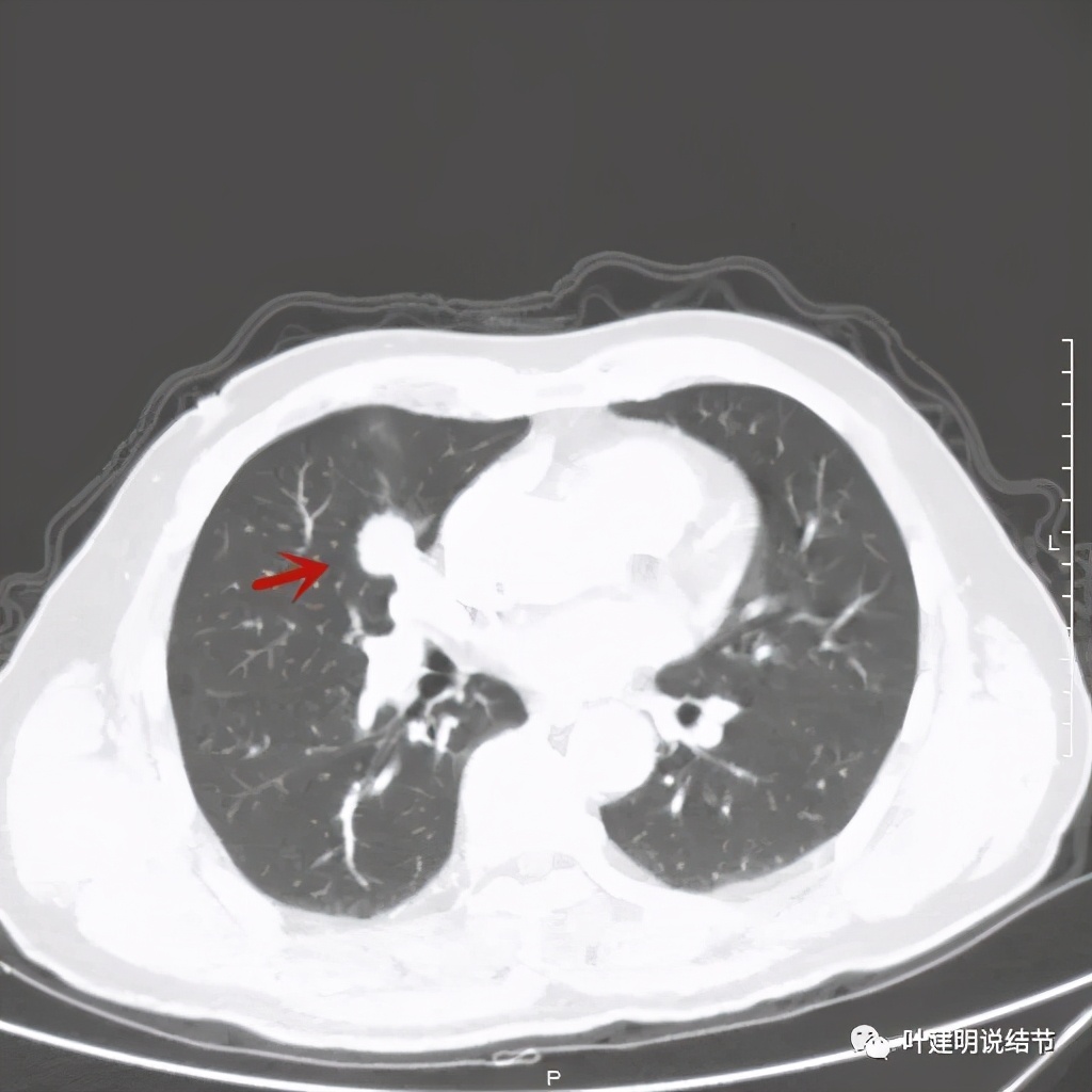 实性结节影要不要紧,实性结节穿刺活检为良性