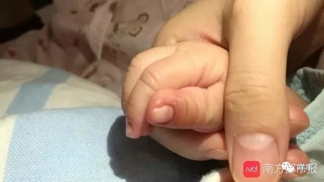 5个月的宝宝有甲沟炎怎么办,满月宝宝甲沟炎怎么办