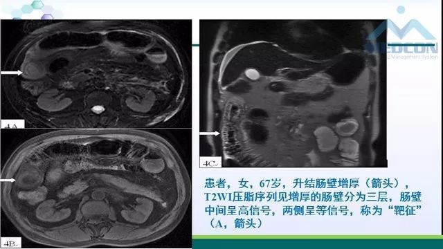 急性胰腺炎的护理措施,急性胰腺炎影像与临床