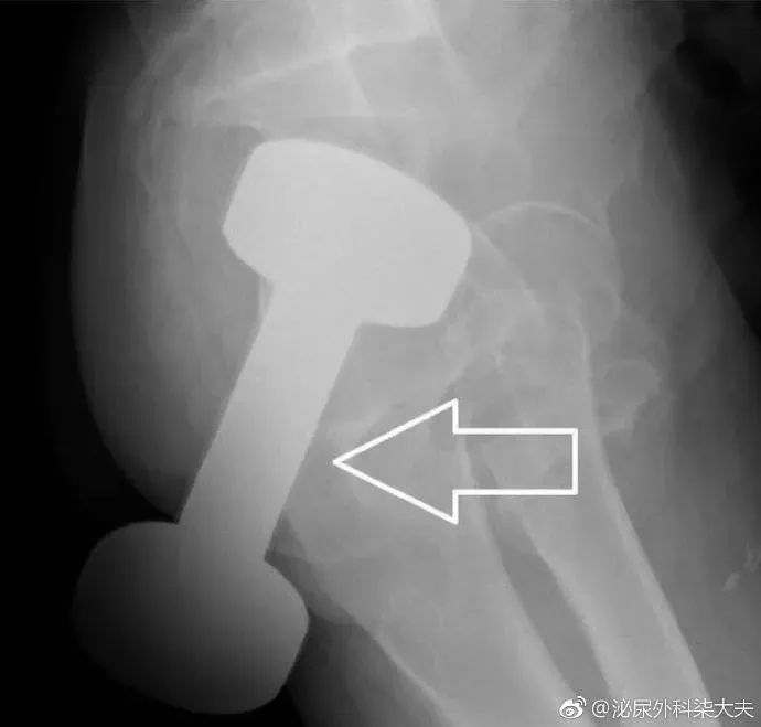 罗非鱼塞进直肠多长时间,罗非鱼直肠