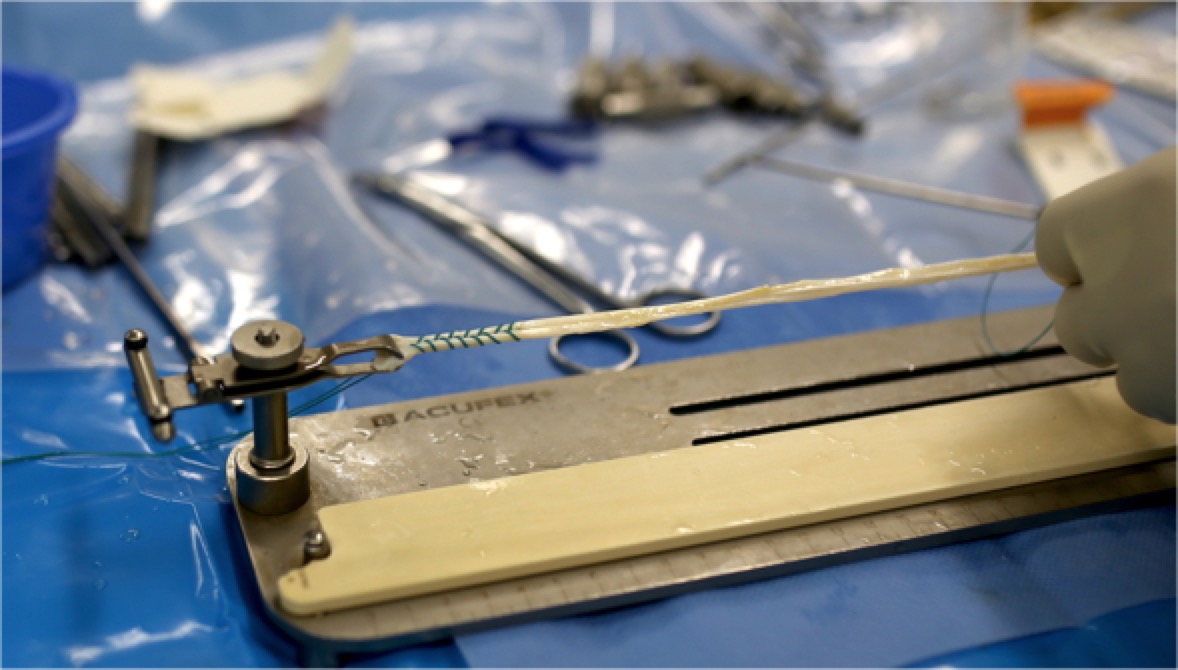 膝盖前叉韧带重建怎么康复,重建膝关节前交叉韧带多久能行走