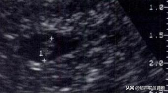 3毫米卵黄囊未见胎芽正常么,40多天的卵黄囊