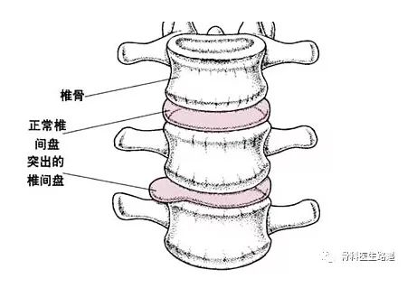 鑵版闂寸洏绐佸嚭鑳芥牴娌讳箞,鑵版闂寸洏绐佸嚭鐥囩姸琛ㄧ幇