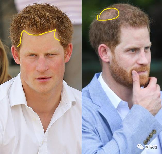 贝克汉姆脱发最新消息,大卫贝克汉姆脱发