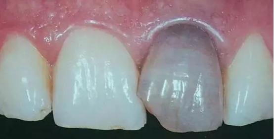 牙齿变黑是口腔癌吗,牙齿变黑了是蛀牙吗