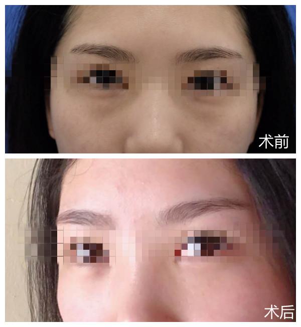 中医治眼袋大泪沟深自己怎么调理,二个方法解决眼袋泪沟七天有效