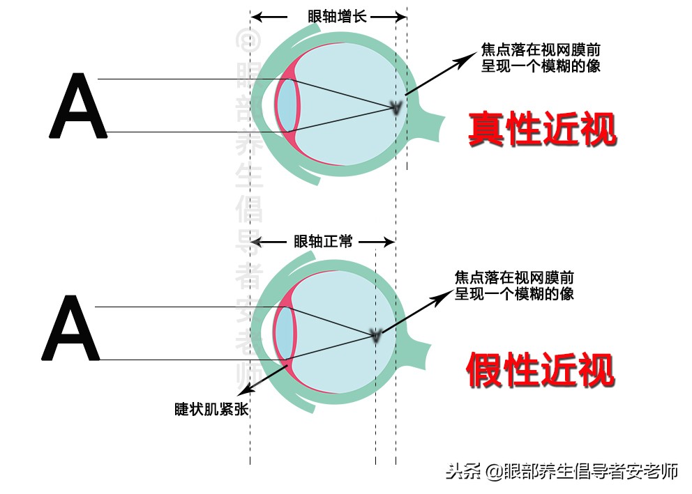 健康科普警惕孩子近视的6个前兆,了解近视的危害和预防方法