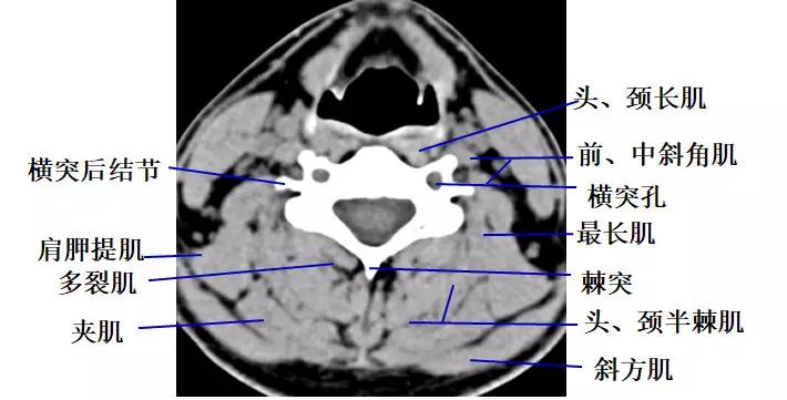颈椎腰椎疾病ct及mri诊断,腰椎ct可以发现肠部病变吗