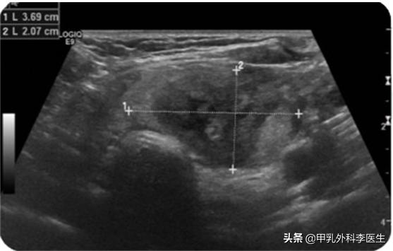 消融术治疗甲状腺结节要多久能好,甲状腺开刀还是消融术