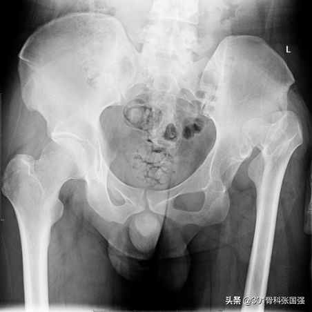 髋关节置换的潘多拉魔盒——术后下肢长短的几种特殊情况