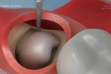 手术的时候医生对你做了什么,手术时切了一片肺叶