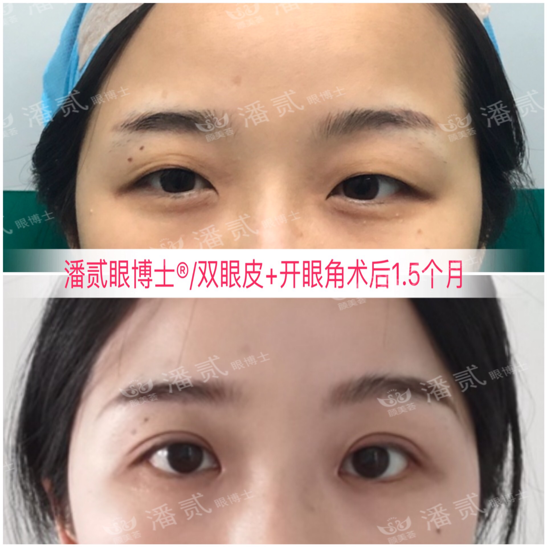 双眼皮眼尾割长了而且上扬怎么办,眼睛眼尾下垂做什么样双眼皮