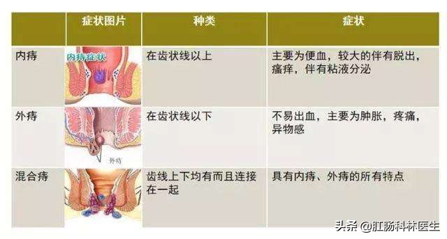 预防痔疮发作可以吃哪些东西,痔疮术后的注意事项及预防