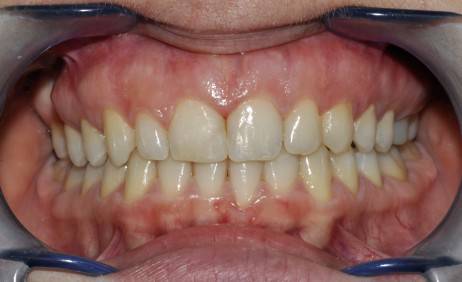 两门牙中间的缝隙越来越大,为什么门牙缝隙大这么难看