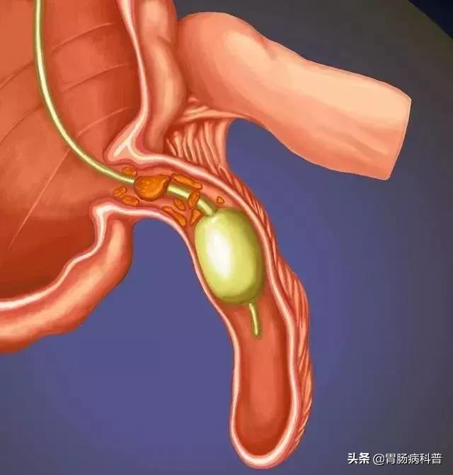 阑尾炎最新内镜微创手术,内镜下阑尾炎治疗术哪里可以做