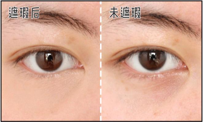 黑眼圈严重怎么办才能彻底去除,黑眼圈严重怎么办快速去除