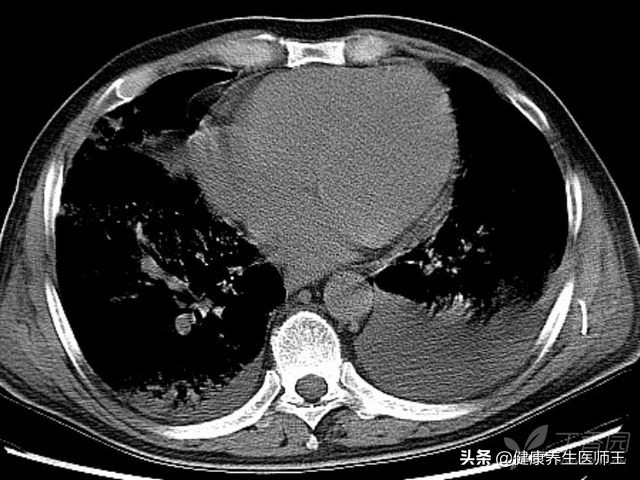 肺部感染的抗生素治疗病例,肺部感染常见的病原菌和抗生素