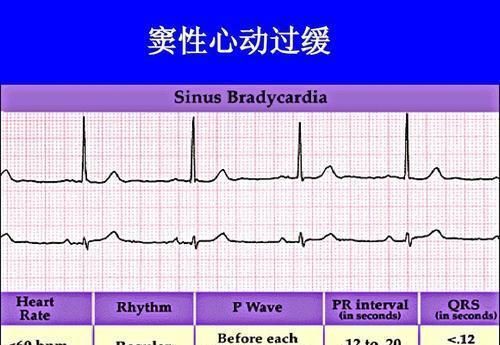 窦性心动过缓一度房室阻滞,心动过缓血压低是怎么回事