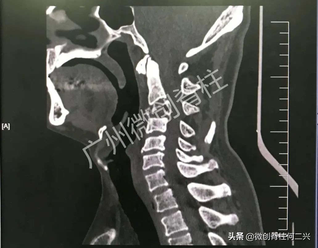 超微创靶点颈椎,微创治颈椎突出效果怎样