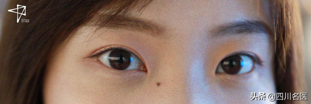 肉痣在癌变之前切除,凸起的黑色痣会癌变会怎样