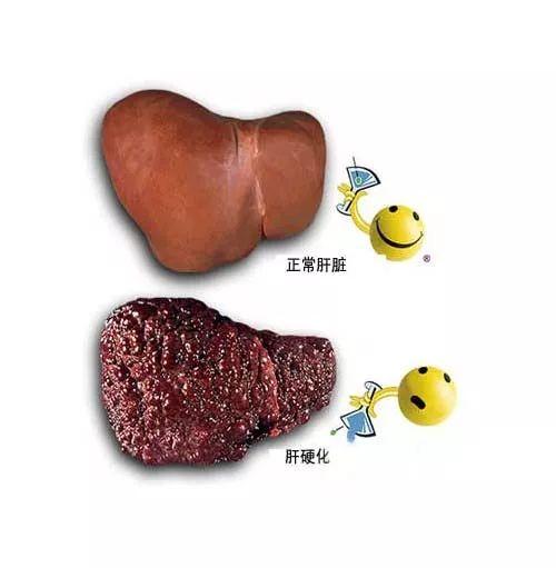 肝硬化抗病毒治疗能逆转脾亢吗,肝硬化了抗病毒还有用吗