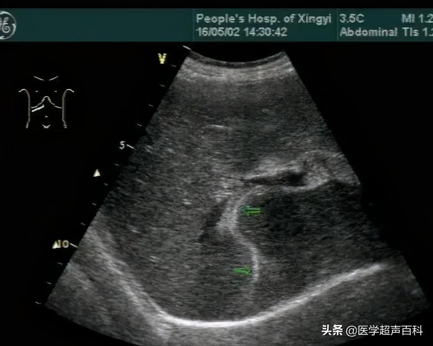 胆道蛔虫症的超声图像特征,超声蛔虫