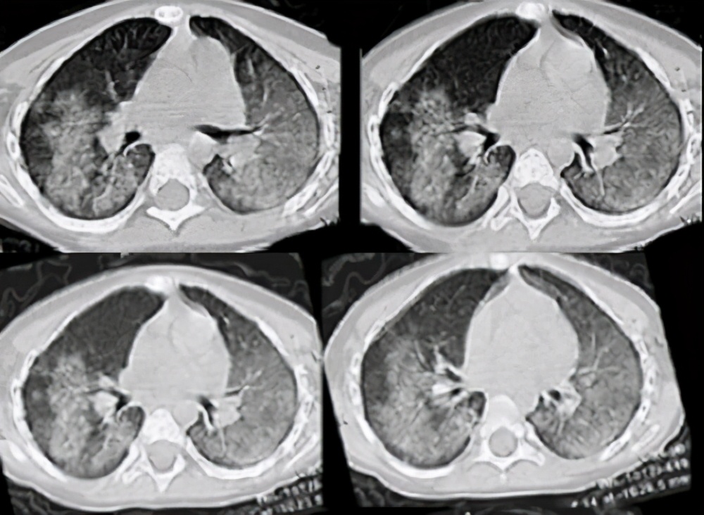肺出血肾炎综合征是由什么导致的,肺出血肾炎综合征有多罕见