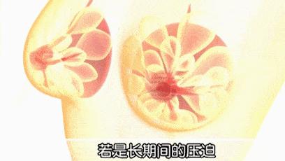 乳腺瘤样增生3-4级能自愈吗,哺乳期乳腺增生多久能自愈