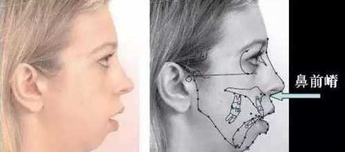 贵族手术的好处,鼻基底手术失败凹陷怎么改善